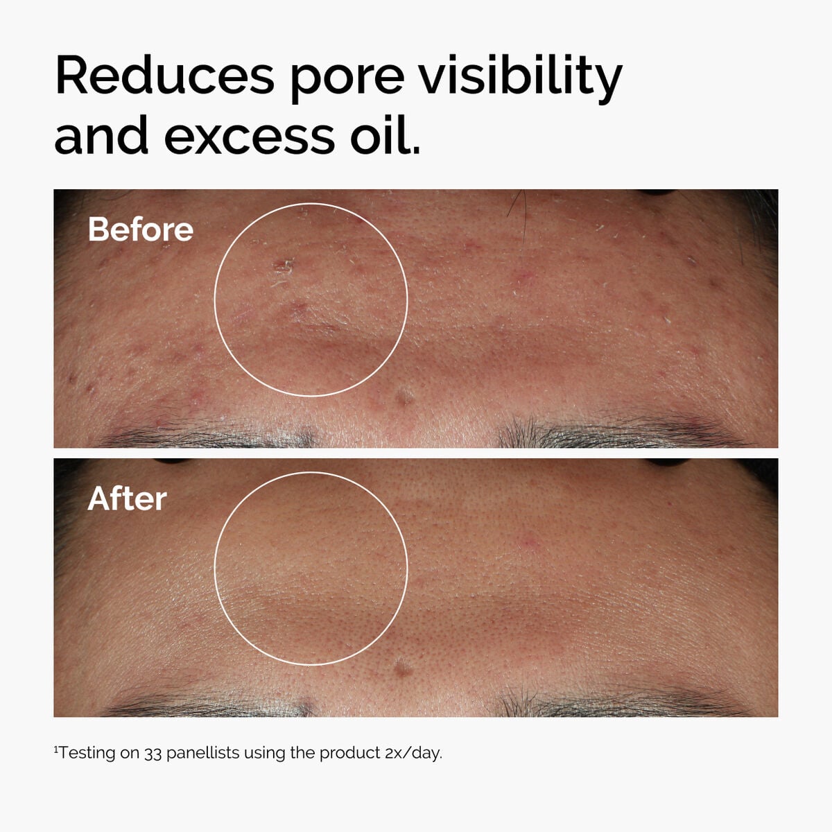 niacinamide-10-zinc-1-q9 ord-niacinamide-zinc-blemish-serum-before-after-pores.jpg