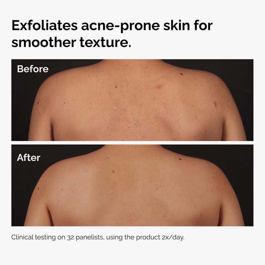 the-body-care-collection-g2 ord-salicylic-acid-body-serum-before-after-graphic-NA.jpg