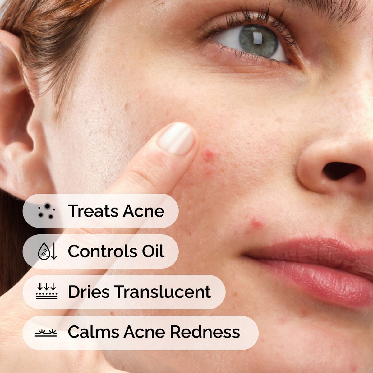 sulfur-10-powder-to-cream-concentrate-l5 ord-sulfur-10pct-powder-to-cream-concentrate-model-application-with-benefits-acne.jpg