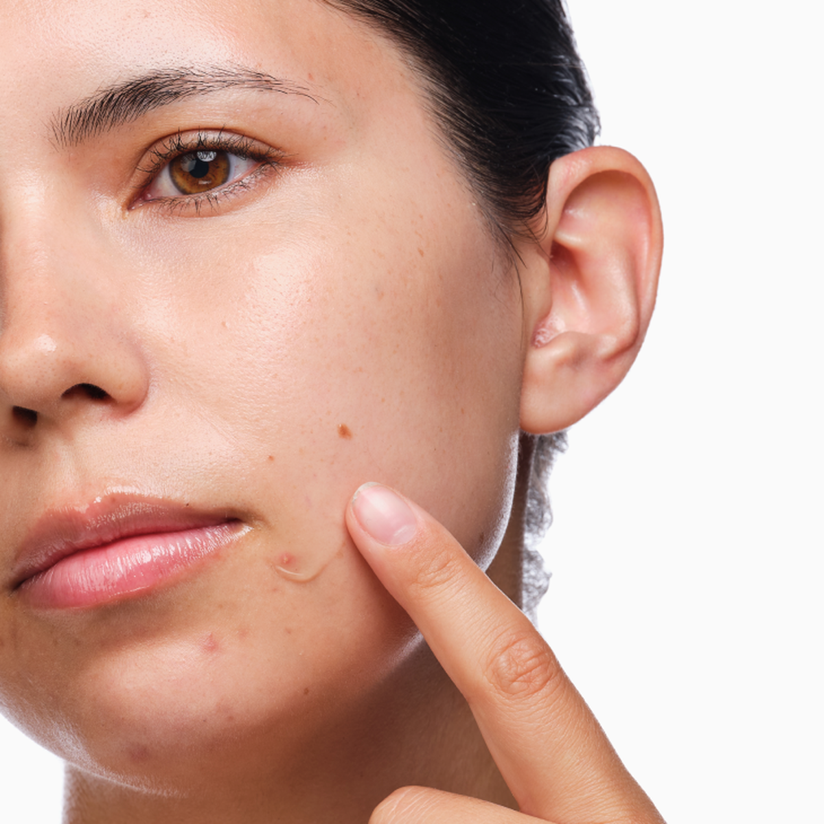 the-acne-set-w4 rdn-the-acne-set-application.png
